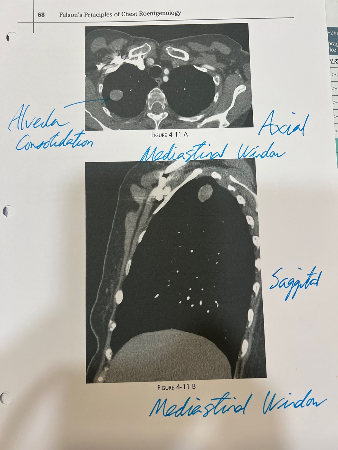 CT Image 11A