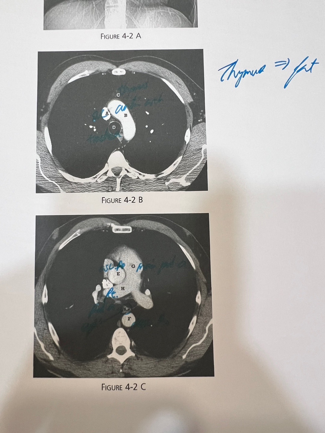 CT Image 2A